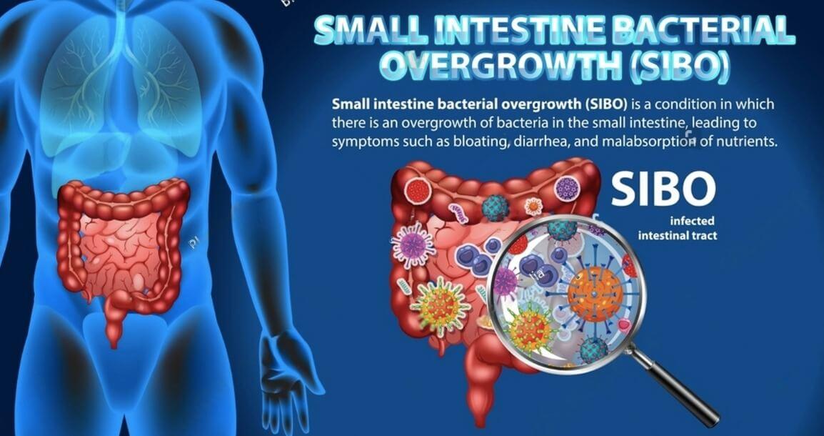 SIBO Treatment Options After a Positive Hydrogen Breath Test