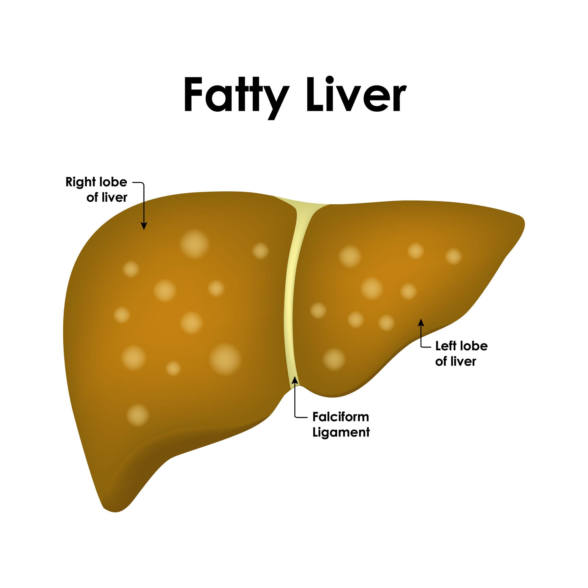 What is fatty liver? How to reverse it?