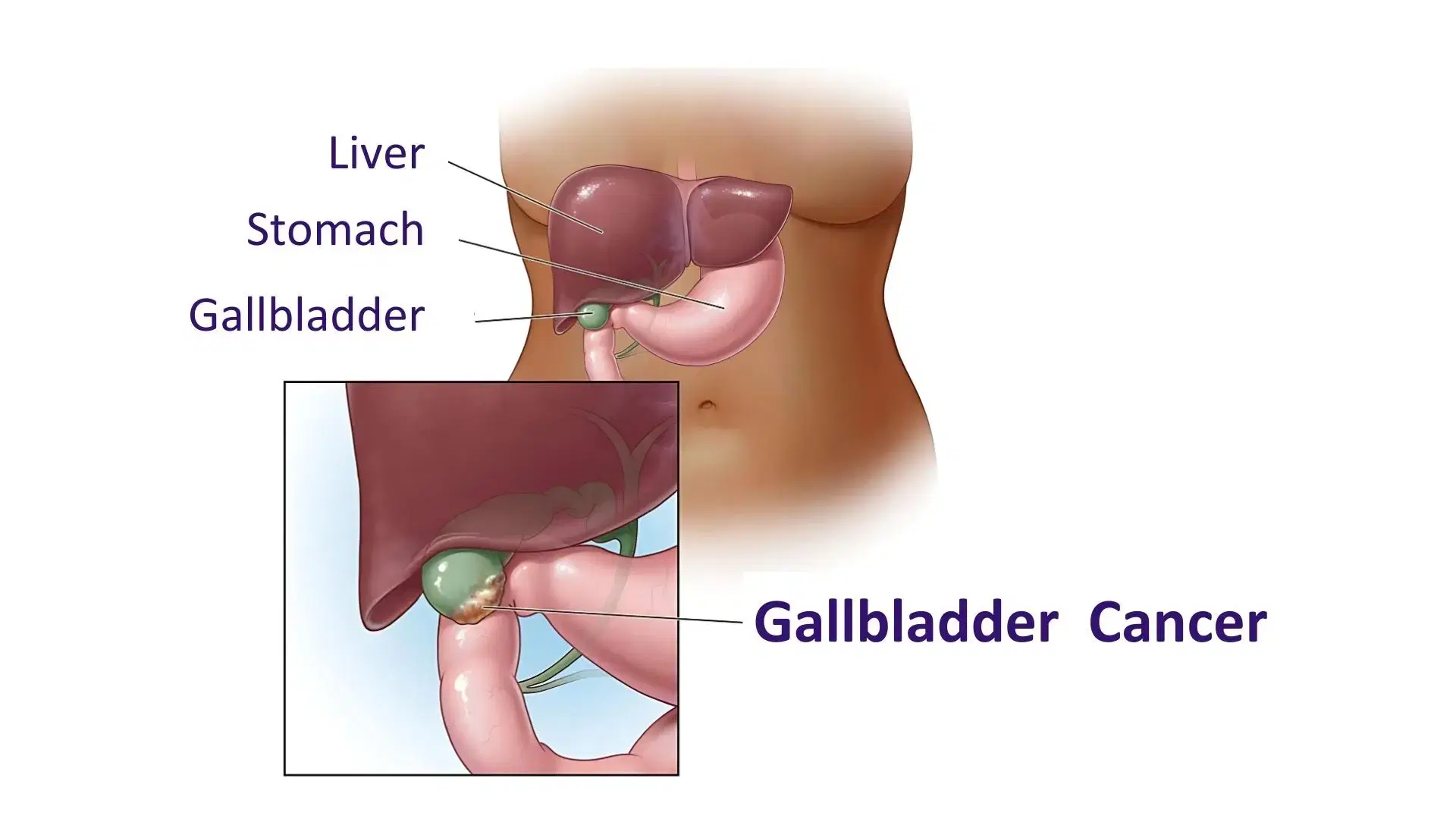 Gall Bladder Cancer