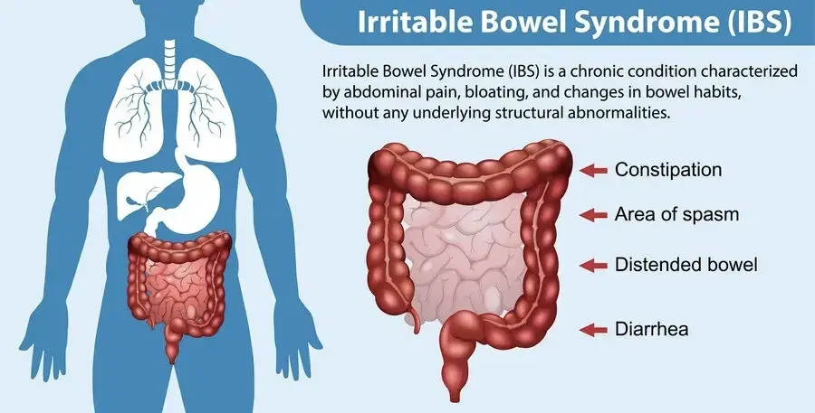 Struggling with IBS Learn Causes Symptoms and Expert Solutions