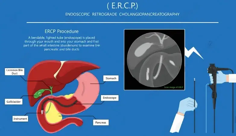 ERCP: Combining Endoscopy and X-Ray to Treat Biliary and Pancreatic Conditions
