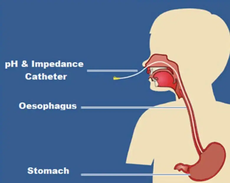 24-Hour pH Impedance Monitoring: Diagnosing Acid Reflux and GERD